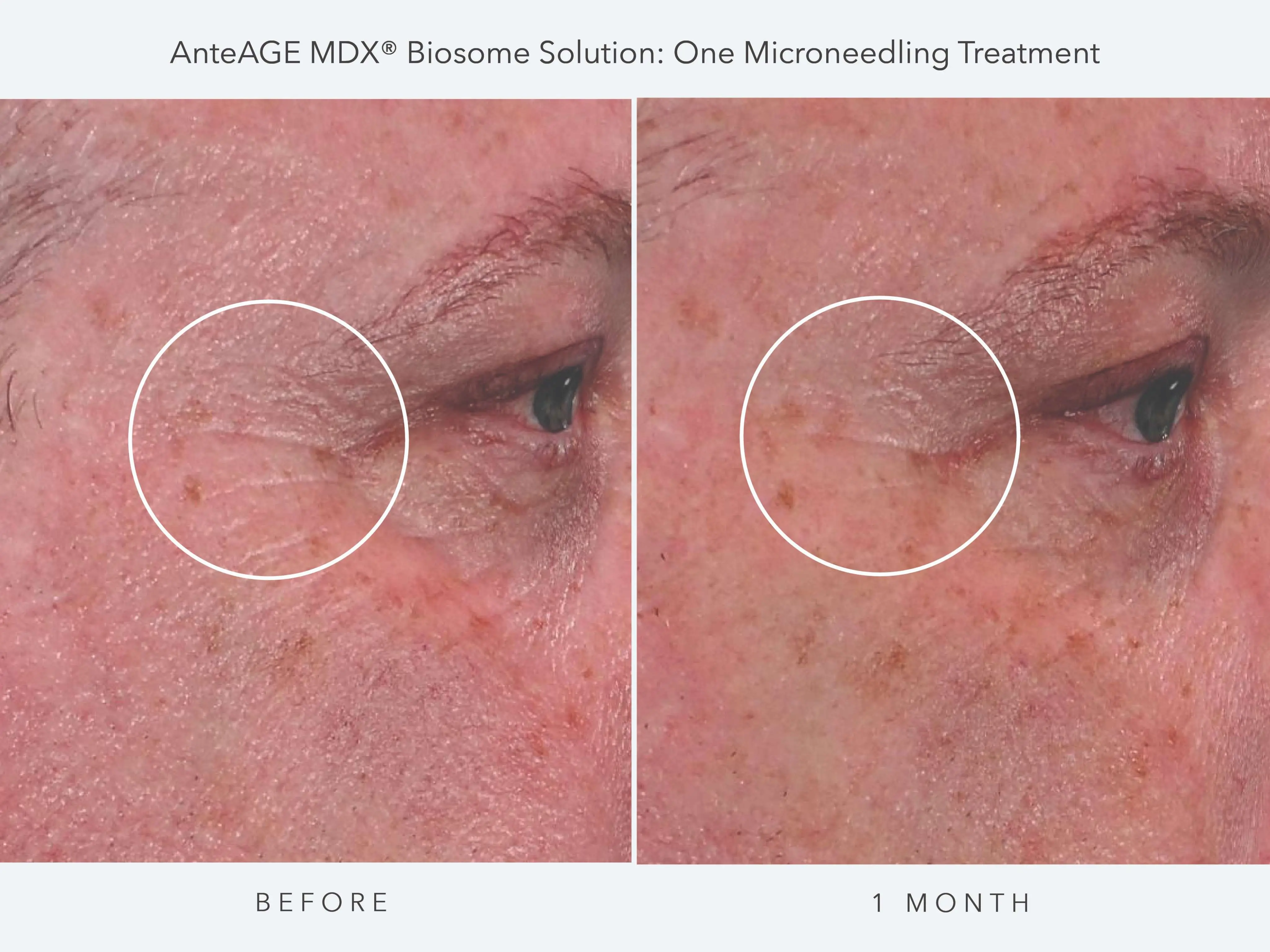 Biosome Treatment Results